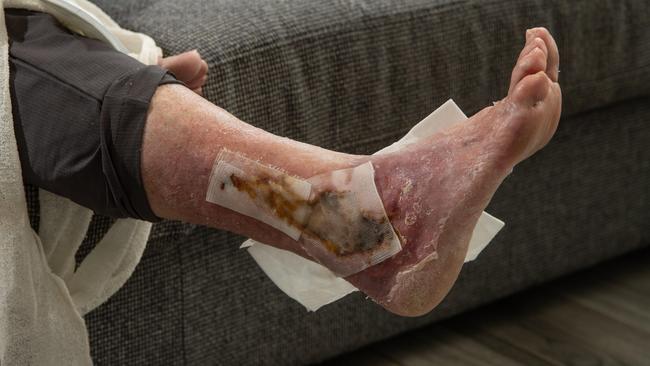 Anne Hunt was recently diagnosed with the flesh-eating Buruli ulcer. Picture: Brad Fleet