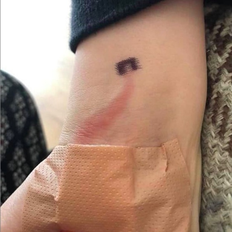 While it looks just like a scratch, this ‘red line’ is actually an early sign of blood poisoning. Picture: Instagram/@tinyheartseducation