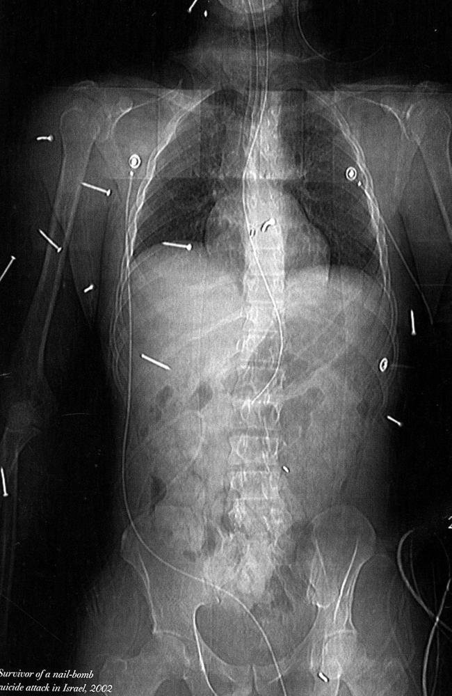 The x-ray of a survivor of a nail bomb suicide attack from 2002.