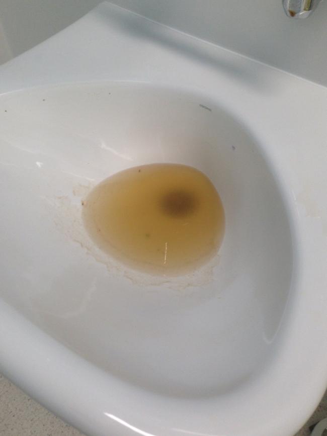 What is believed to be sewage in the sink at the Northern Beaches Hospital.