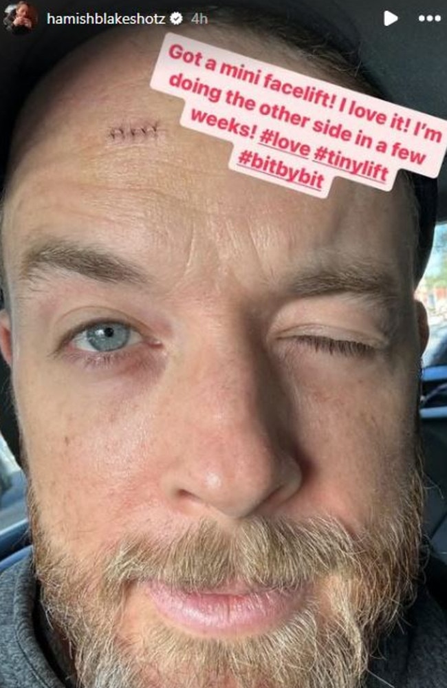 Hamish Blake shares post-surgery photos after skin cancer scare