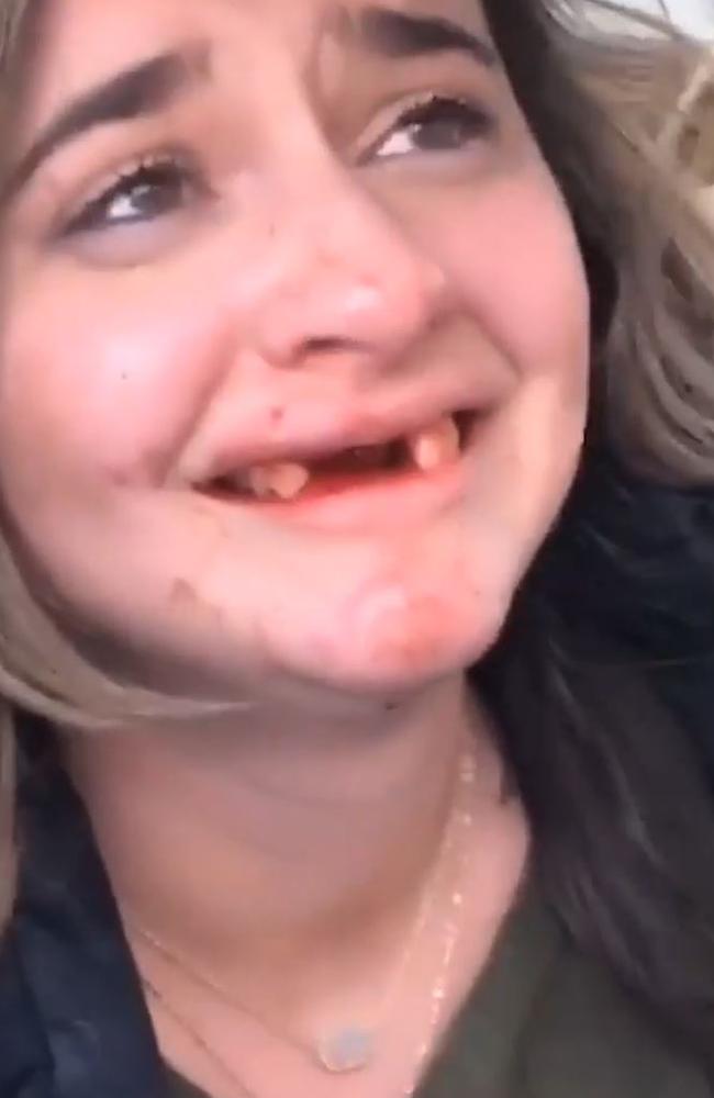 Woman Loses Front Teeth During Boozy Tiktok Act Video Au — Australias Leading News Site 3719