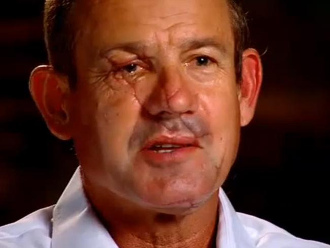 Greg Pickering a few months after the shark attack. Picture: Channel 7