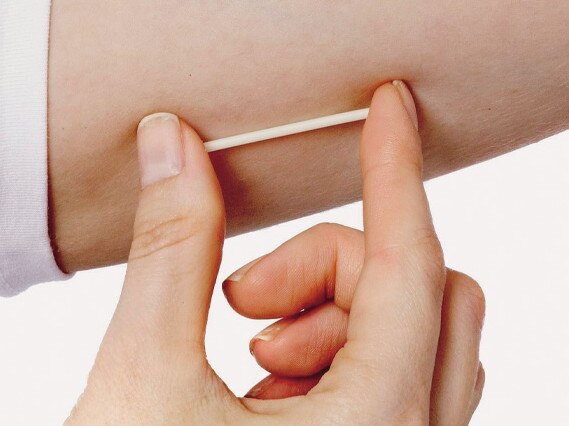 The contraceptive implant.