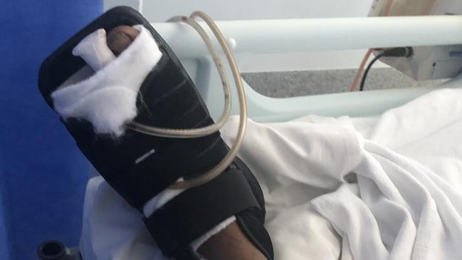 Leroy Daly's injured left foot after surgery. Picture: Supplied