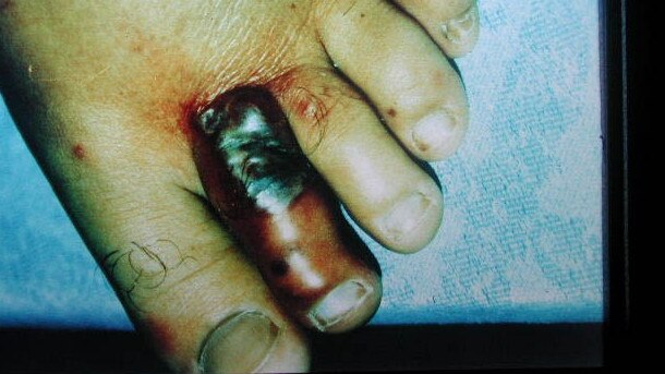 A patient’s toe after contracting melioidosis.