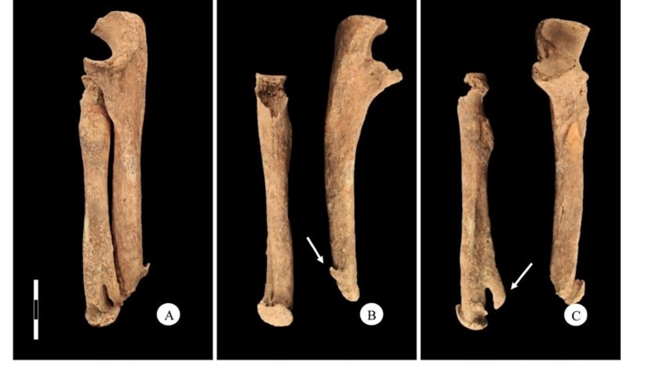 Views of the right forearm’s healed fracture, to which the prosthetic sword was attached.