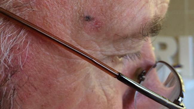 Dr Michael Armstrong, 69, of Manly, noticed an abnormal looking mark on the right side of his temple in early 2014, which turned out to be melanoma. Picture: Supplied.