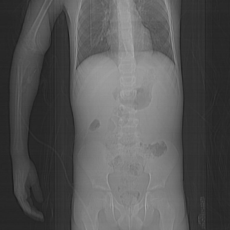 A few hours later he began to vomit, unable to walk. A CAT scan later revealed he had perforated his spleen and had free fluid in his abdomen. Picture: Supplied