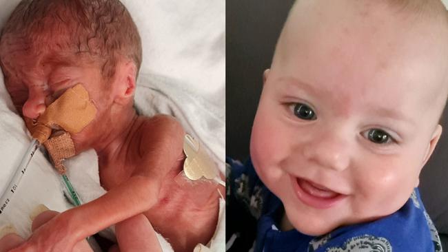 Miracle baby Theo this week celebrated his first Birthday. Picture: Supplied