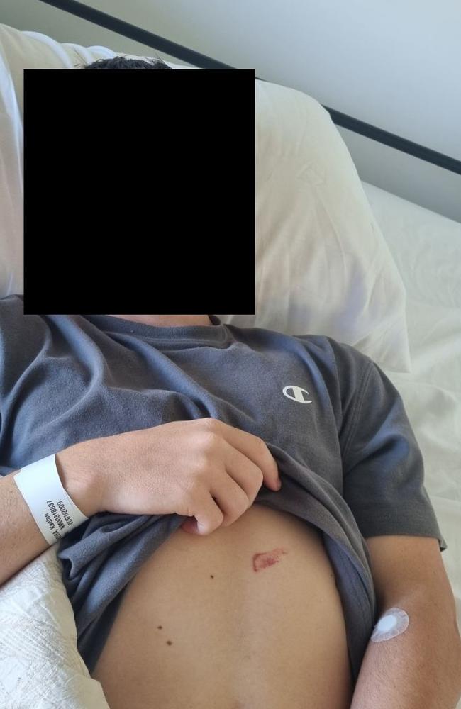 Bruising caused by the handlebars impacting on the boy’s torso. Picture: Supplied