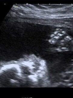 An ultrasound of unborn baby Nathan.