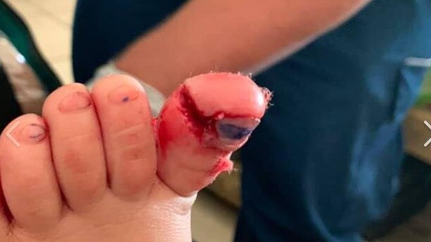 The injured toe. Picture: supplied