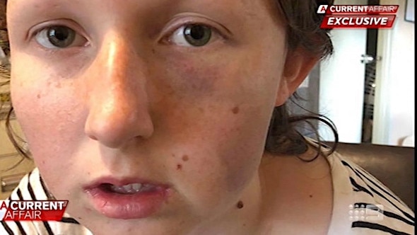 Kayla Kendrigran suffered serious injuries during the ordeal, including extensive bruising and swelling to her face. Picture: A Current Affair