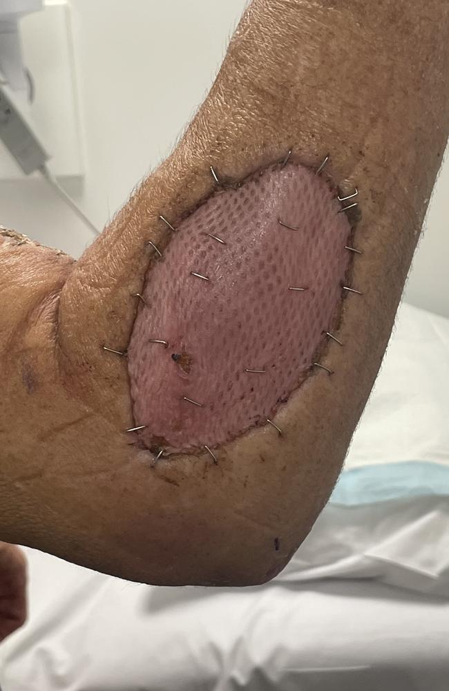 Andrew Emmerig, of Brisbane, nearly lost an arm due to ocean bacteria while holidaying on the Sunshine Coast. Picture: Contributed.