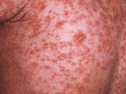 A person infected with the deadly measles virus travelled from Sydney to Rockhampton before they were diagnosed.