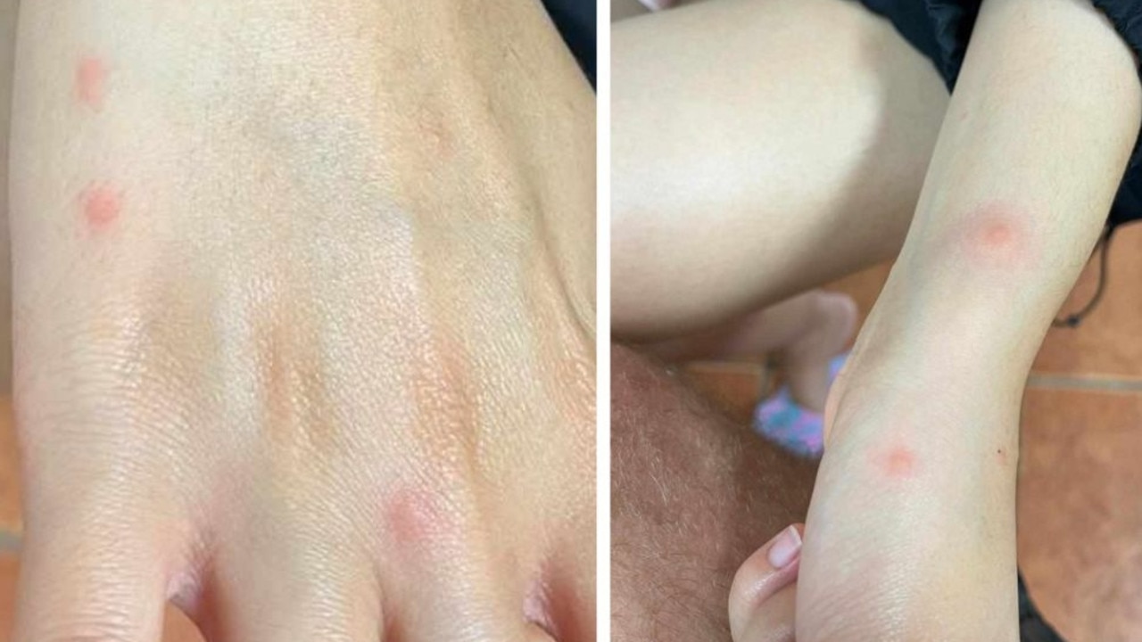 Guests have complained of bed bugs, and allege not much has been done to prevent the spread. (Photo supplied by a hostel guest)