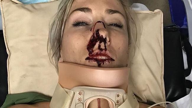 Caroline Buchanan posted this shocking image on Instagram in the aftermath of her car crash. Picture: Caroline Buchanan/Instagram
