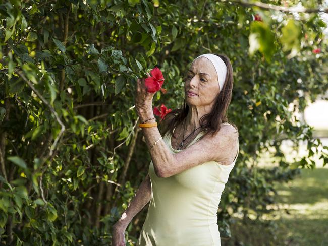 Carol Mayer was 33 when she sustained burn injuries to over 80% of her body in a house fire in February 2000. Photo: Mark Cranitch.