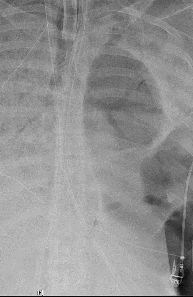 An X-Ray showing the woman’s damaged lungs, released by Northwestern Medicine. Picture: Northwestern Medicine/AFP