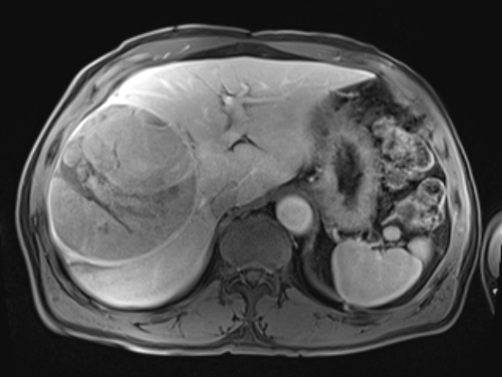 The massive tumour (left) as seen in an X-ray