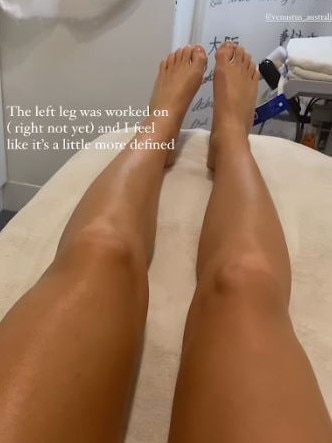 The 37-year-old posted a side-by-side photo comparing the results in her left and right leg. Picture: Instagram