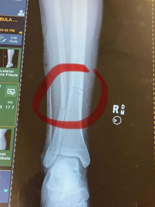 An x-ray of the horrific leg break that landed golfer Sarah Kemp in hospital.