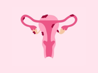 10 ways to better manage the symptoms of endometriosis. Image: iStock