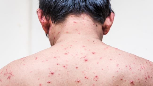 Chickenpox numbers are on the rise in Central Queensland