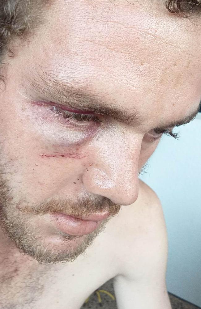 Millner resident Jayden Kearney has suffered an eye socket fracture, jaw fracture, chipped teeth and split lips as a result of a road rage attack at Coolalinga. Picture: Supplied