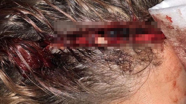 The youth justice worker’s skull became exposed after she was "scalped". The Herald Sun chose to pixellate the graphic image. Picture: Supplied