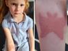 7-year-old girl ‘scarred’ by temporary tattoo