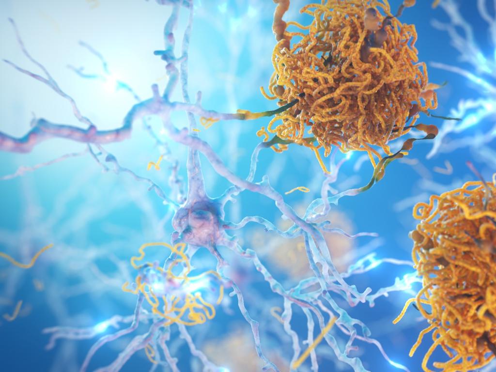 Amyloid plaques responsible for Alzheimer's disease. Picture: Supplied
