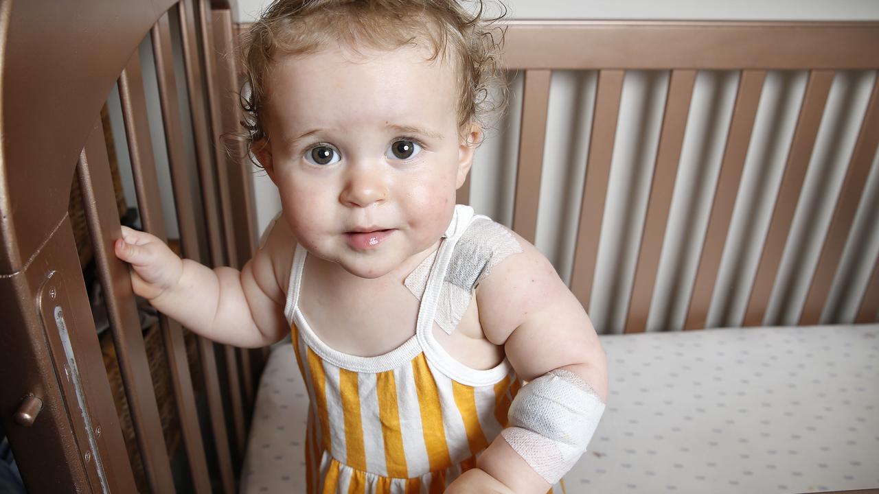 Fenella, 1, suffered burns after a bathroom light exploded glass over her. Picture: David Caird