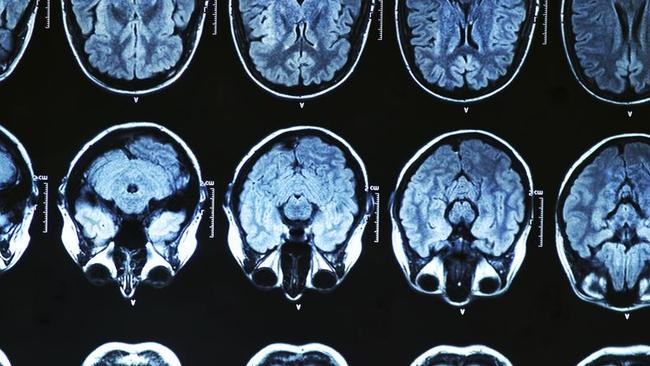 Scientists analysed brain activity to allow locked-in patients to say a simple yes or no when asked questions