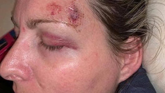 Port Lincoln nurse Amanda Treagus was injured in an assault at work.