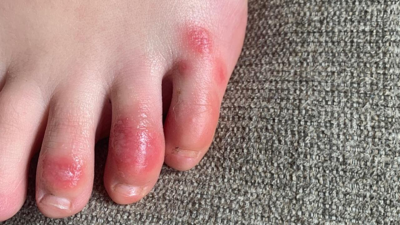 Covid toes emerged as a symptom early in the pandemic. Picture: Dr Amy Paller, Northwestern University