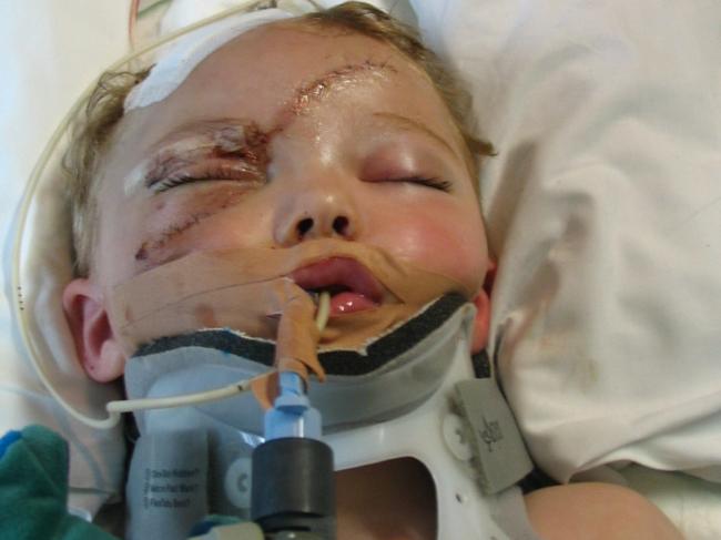 Layton Smith in 2004, then aged 2, recovering in hospital from being hit in a car crash that is in 2016 the subject of a NSW Supreme Court appeal. Picture: Supplied