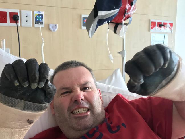 Jason 'Buddy' Miller of Queenscliff at Northern Beaches Hospital. As a result of sepsis he will lose both his hands and feet. Picture: Supplied.