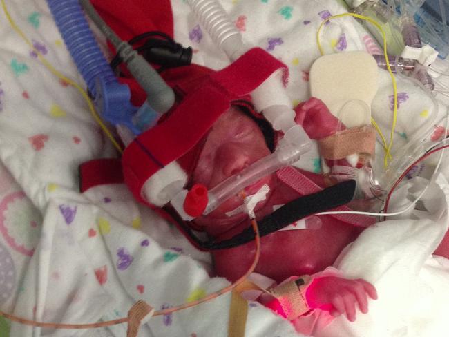 Premature baby, Maggie Wiltshire, taken on her birth day (12.12.2012). Picture: Supplied