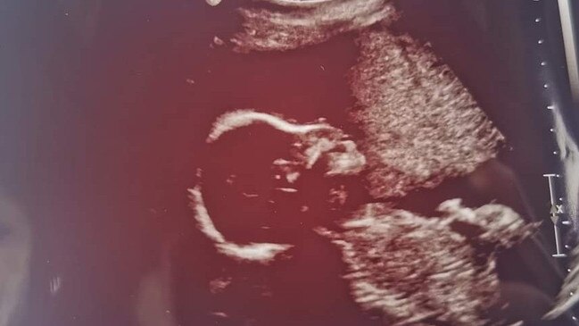 A scan of baby Fallon.