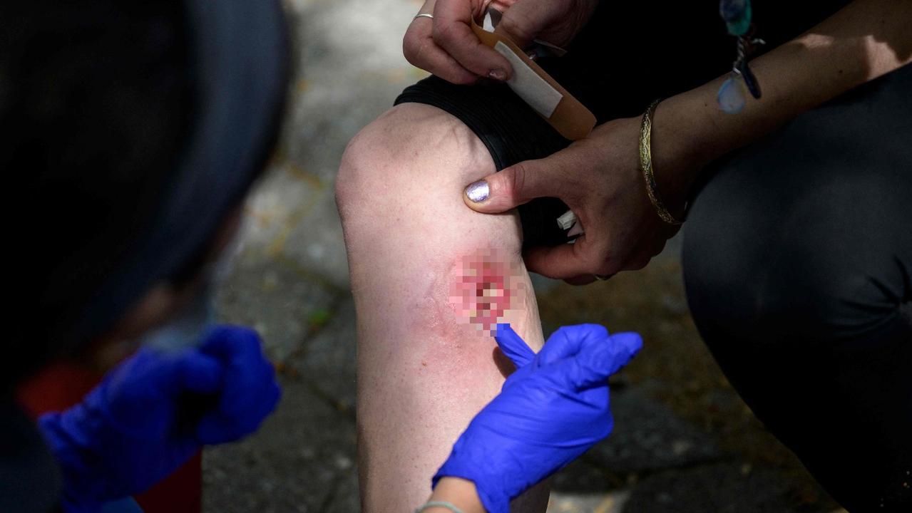 A new drug, known as ‘Tranq’, doing the rounds in the US is leaving severe wounds. Picture: AFP