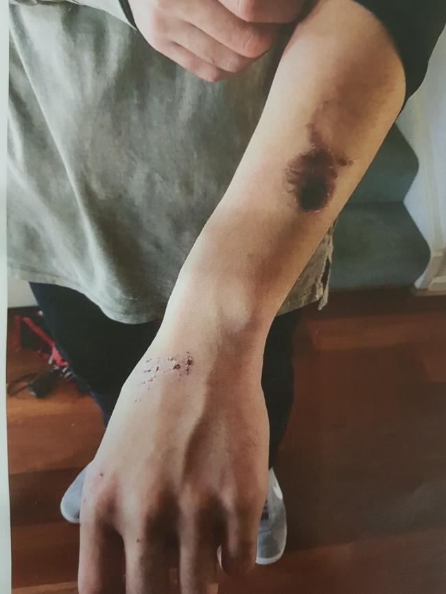 Police photograph tendered to court of Fan Chi Kong’s arm. Picture: SA Police