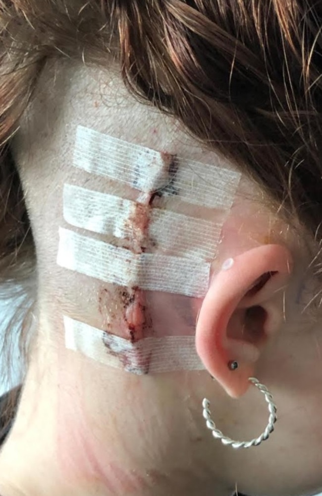 Doctors had to drill a hole in Paige’s skull to perform the biopsy. Picture: Supplied