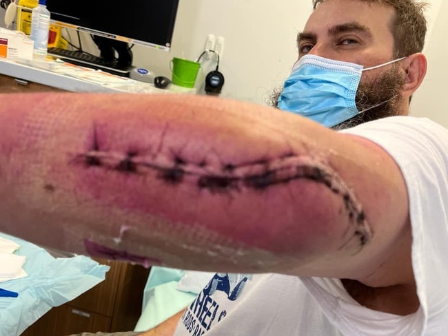 Paul Burkett had three operations to clean out his elbow, thumb and finger after a Strep A infection. Photo: Paul Burkett, Facebook.