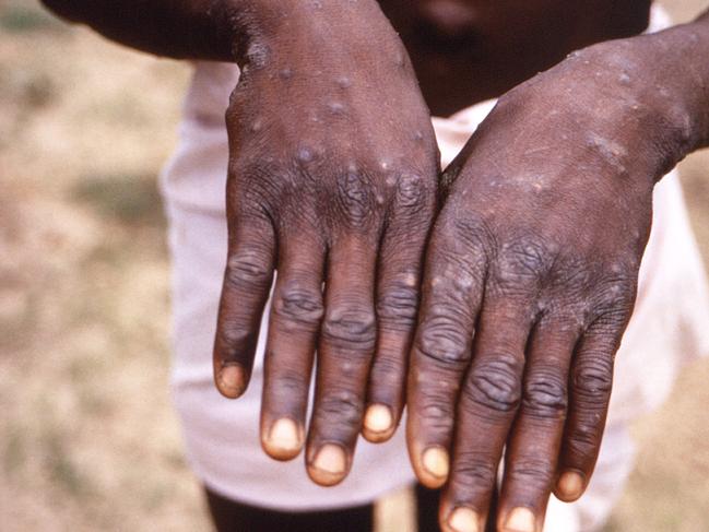 A photo released by the CDC of how monkeypox affects people. Picture: CDC.