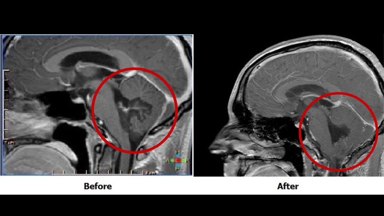 Tomlinson’s before and after MRI scans. The red circles show where the tumour and remaining hole. Picture: supplied