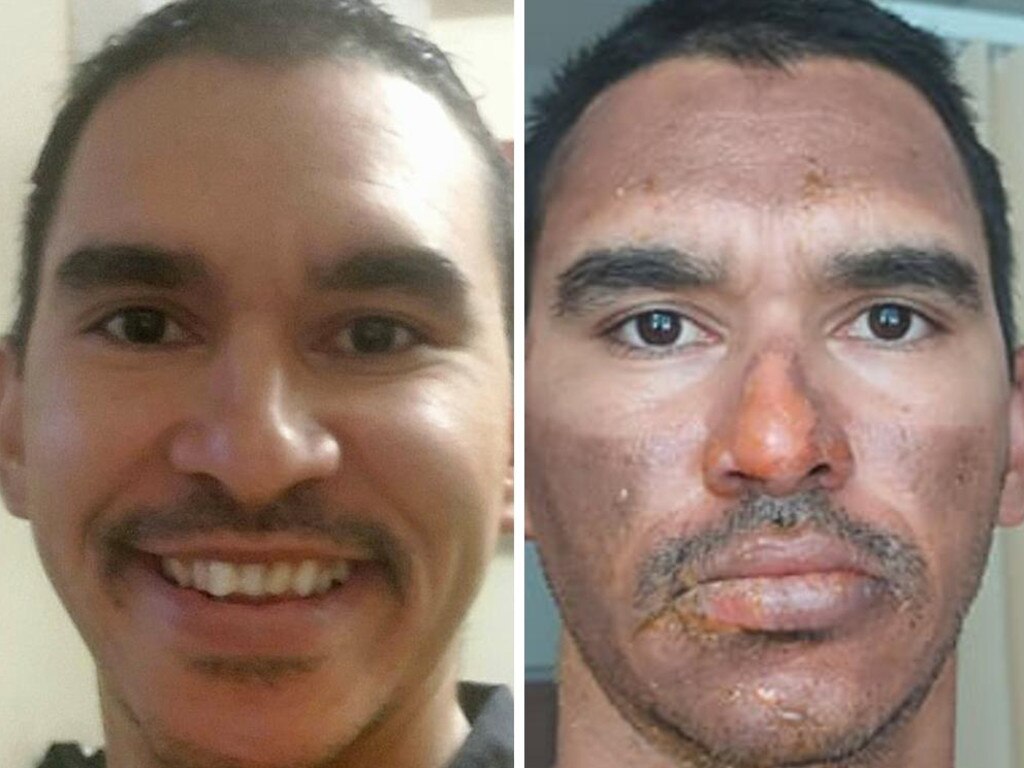 Central Queensland miner Nigel Purcell has been left battling third-degree burns to his face after a lawn-mowing incident gone horrifically wrong.