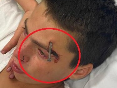 Riley Scott was shot in the head with a nail gun