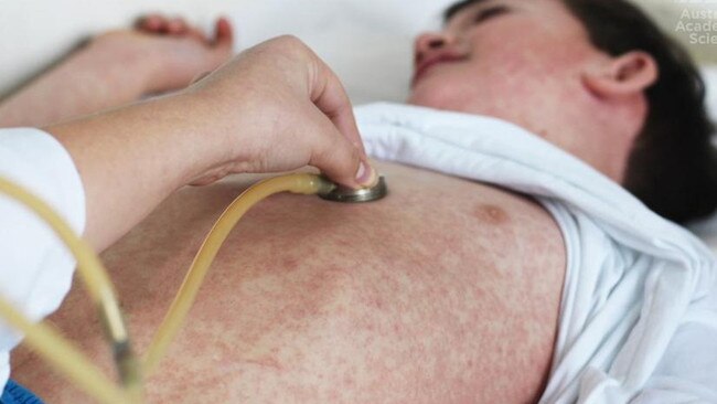 Eight new measles cases have been diagnosed in Queensland.